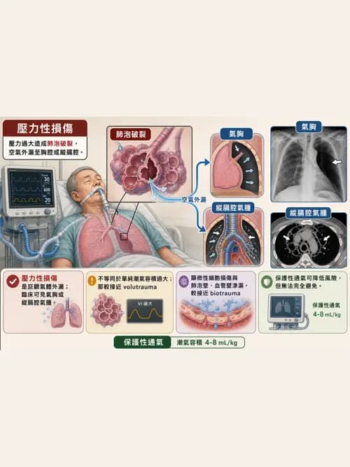 呼吸治療師 - 呼吸器併發症與感染 - AI 圖文解析預覽